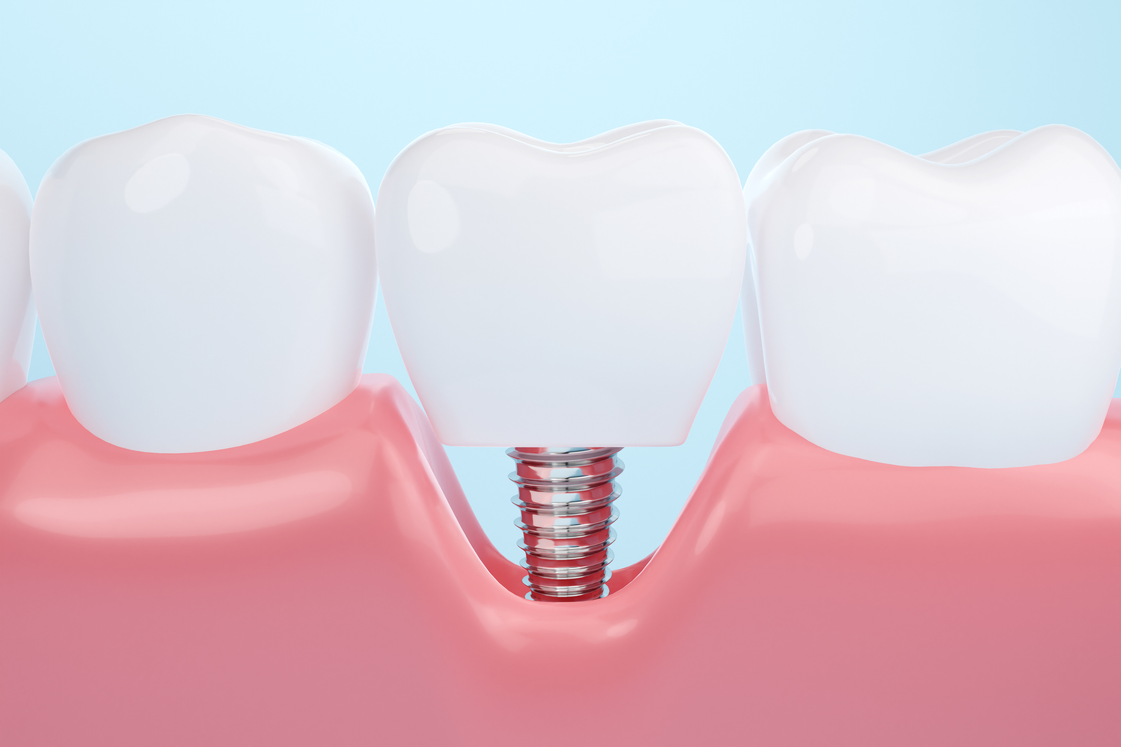 how-do-dental-implants-work